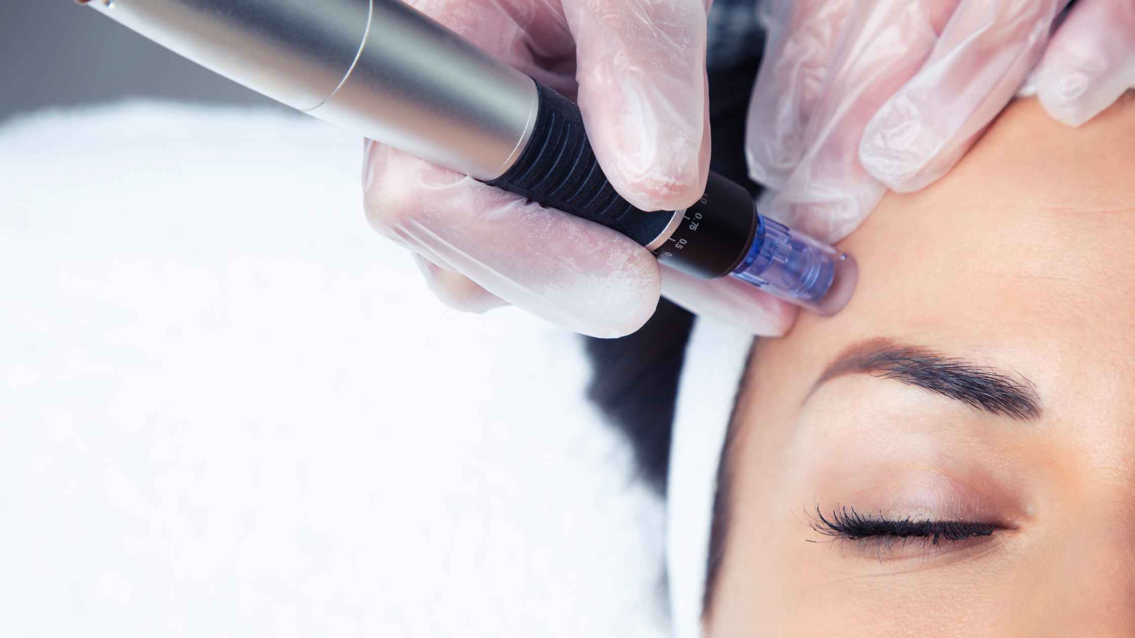 Exploring Microneedling: Benefits and What to Expect