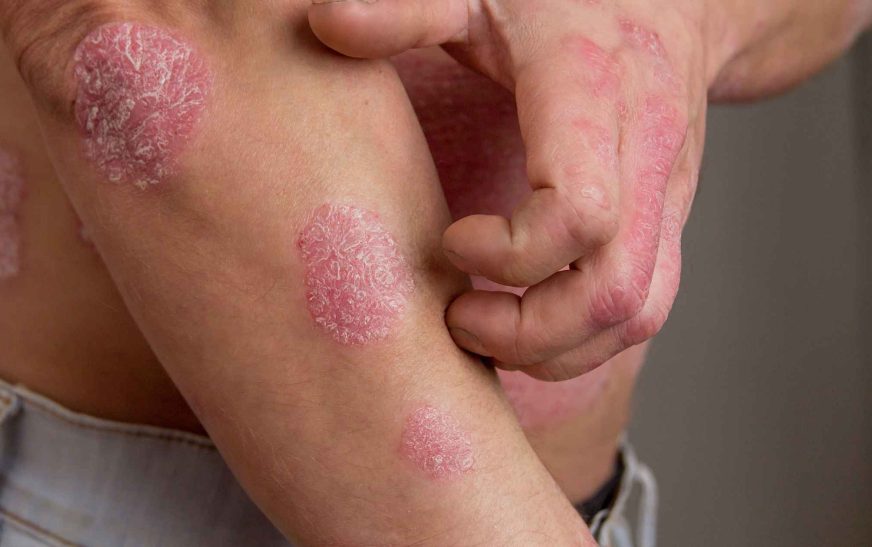 Psoriasis Uncovered: Symptoms, Triggers, and Management Strategies