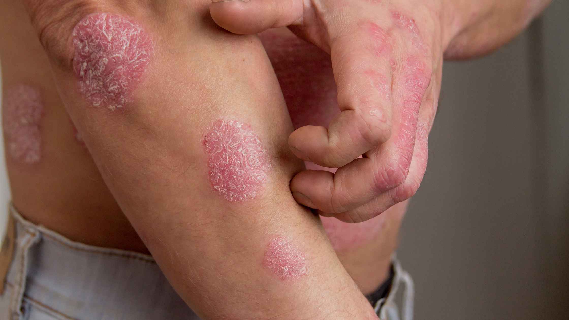 Psoriasis Uncovered: Symptoms, Triggers, and Management Strategies