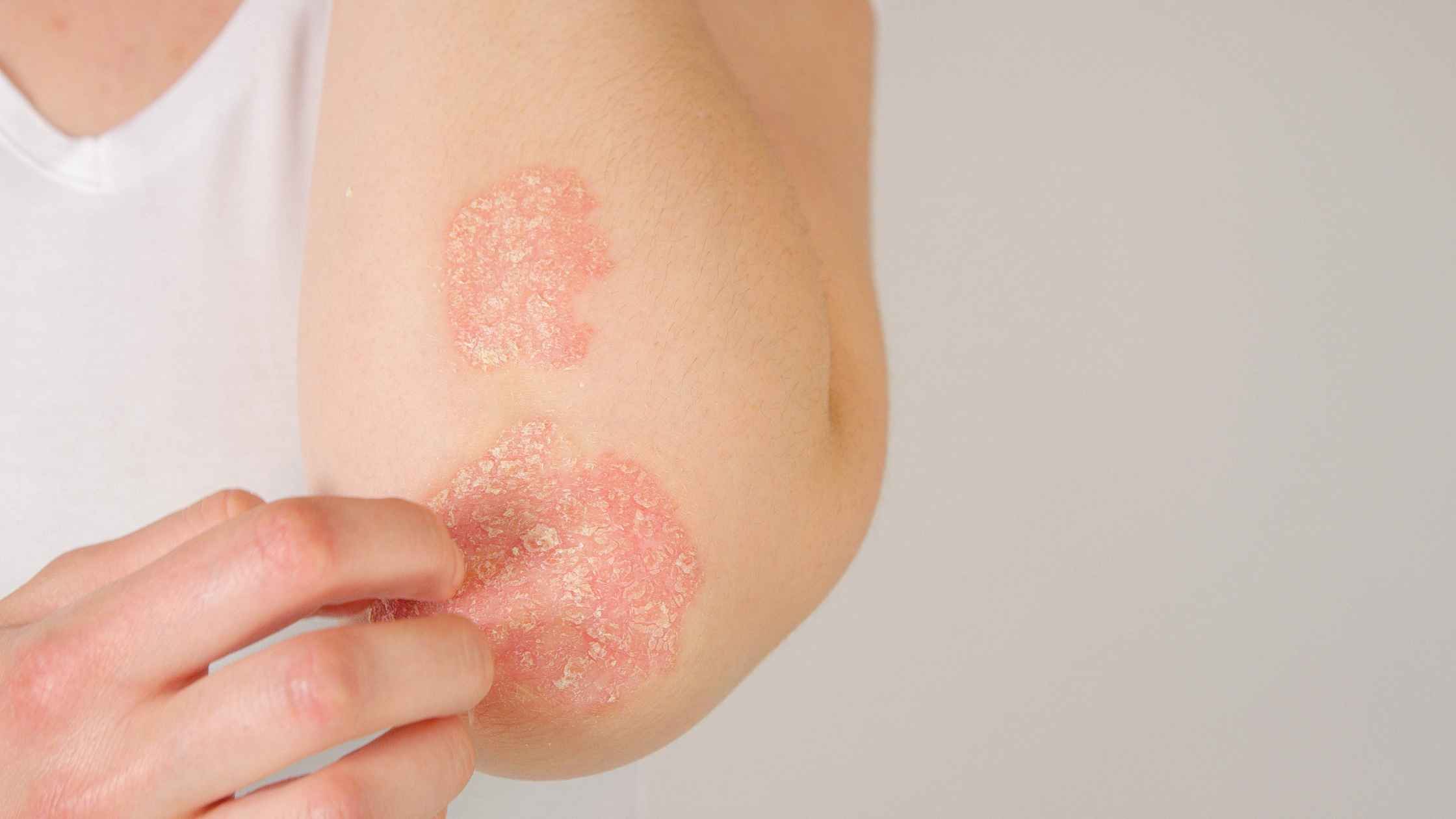 Understanding Eczema: Causes, Symptoms, and Treatments